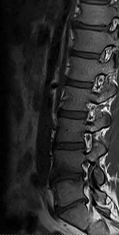 Antibiotic spine treatment