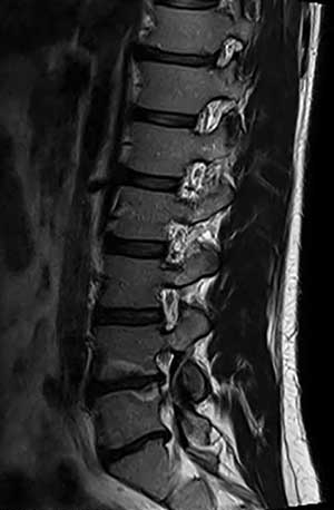 Antibiotic Spine Treatment