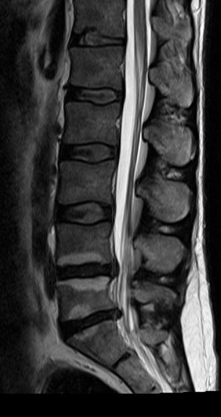 Antibiotic Spine Treatment